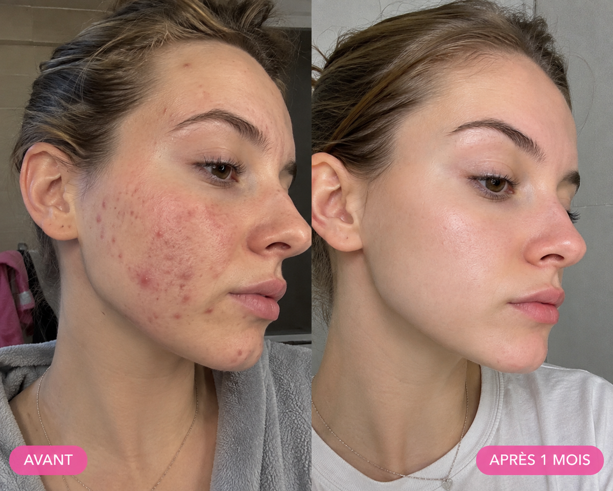 GlutaMaster Anti Acne Set original
